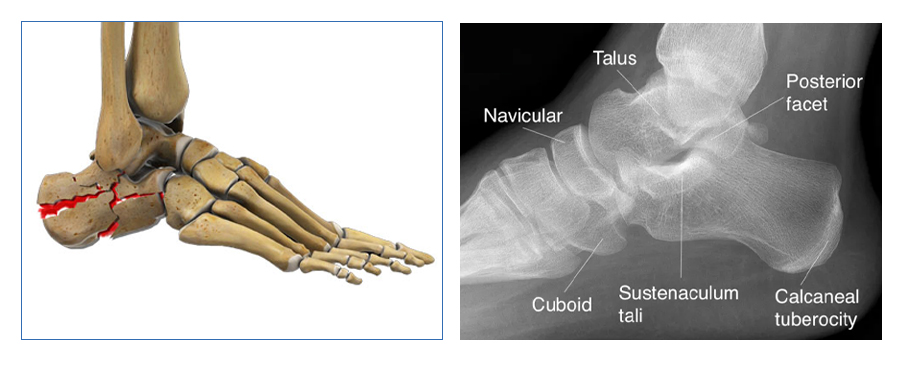 कॅल्केनियस-बोन-शरीर रचना-आकृती-czmeditech