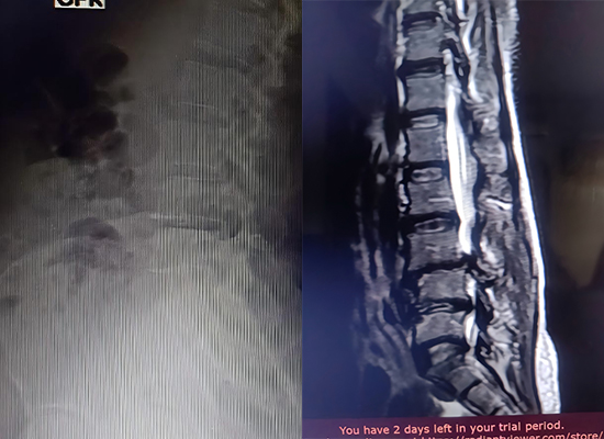 lumbar spine stenosis preoperative X-ray