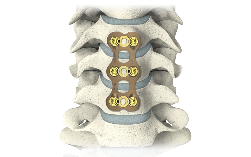 NovaFix-II-Anterior-Cervical-Plate