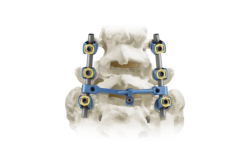 Spinal Pedicle Screw System