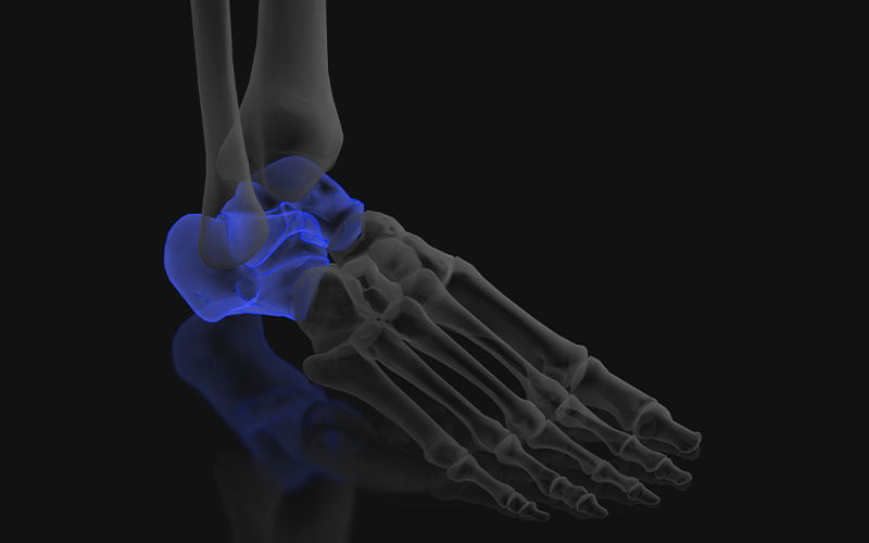 Hindfoot bones highlighted in blue on a foot anatomy illustration