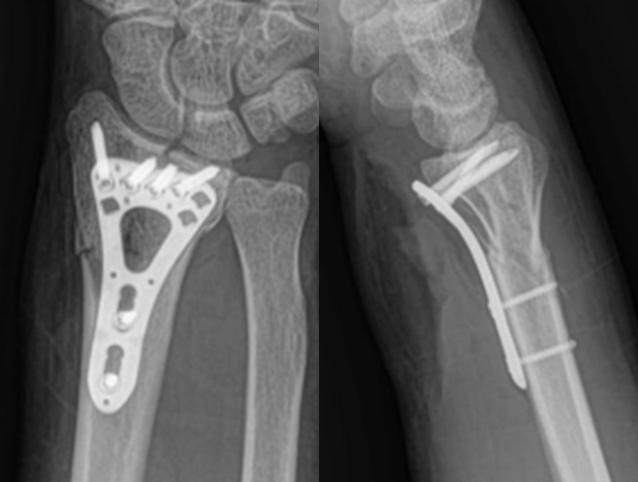 Postoperative wrist X-rays