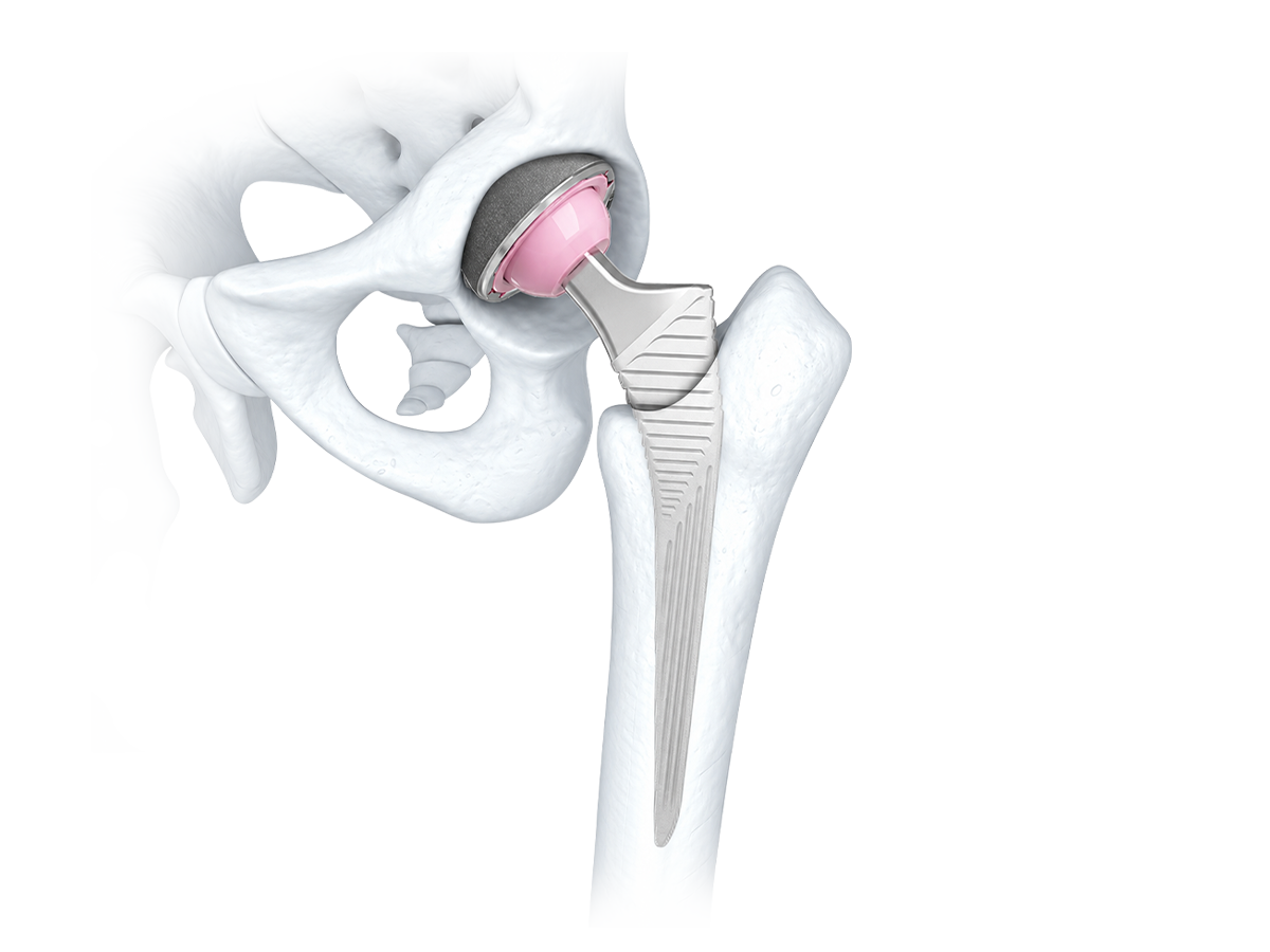 HIP REPLACEMENT SYSTEM-czmeditech.png
