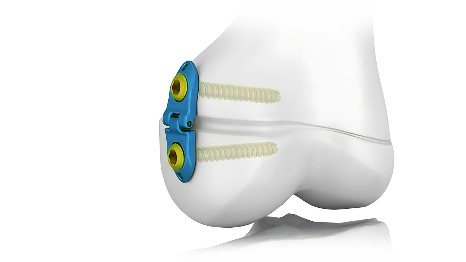 Pediatric locking plate system