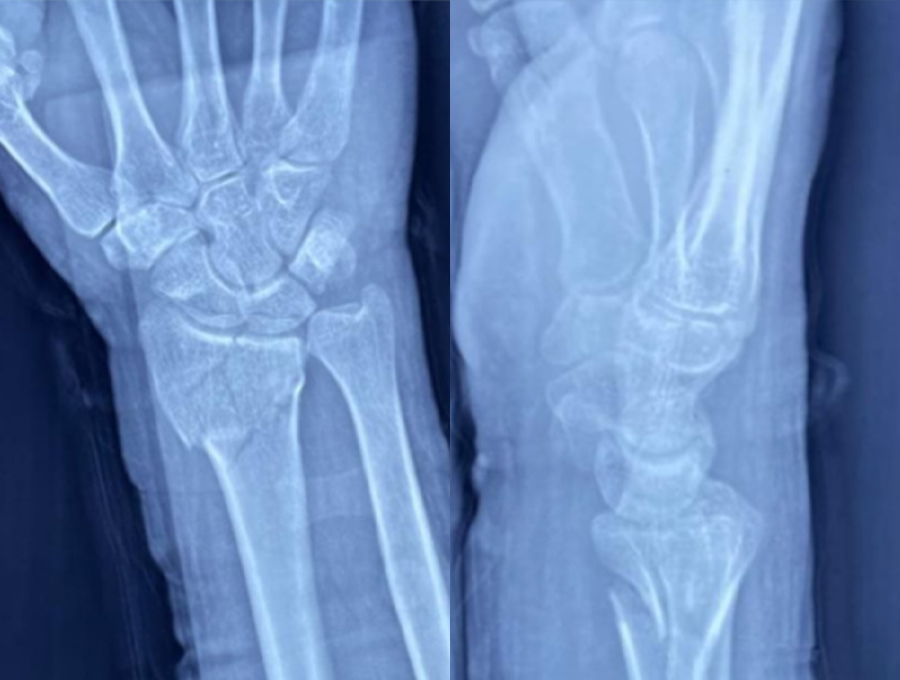 Preoperative wrist X-rays