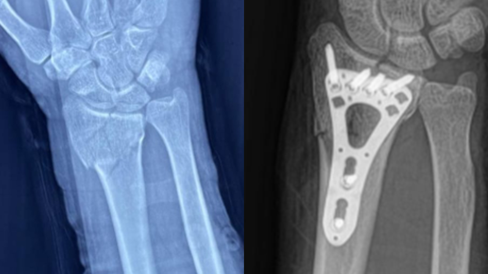 Successful Distal Radius Fracture Surgery in Mexico — Using CZMEDITECH VA Locking Plate System