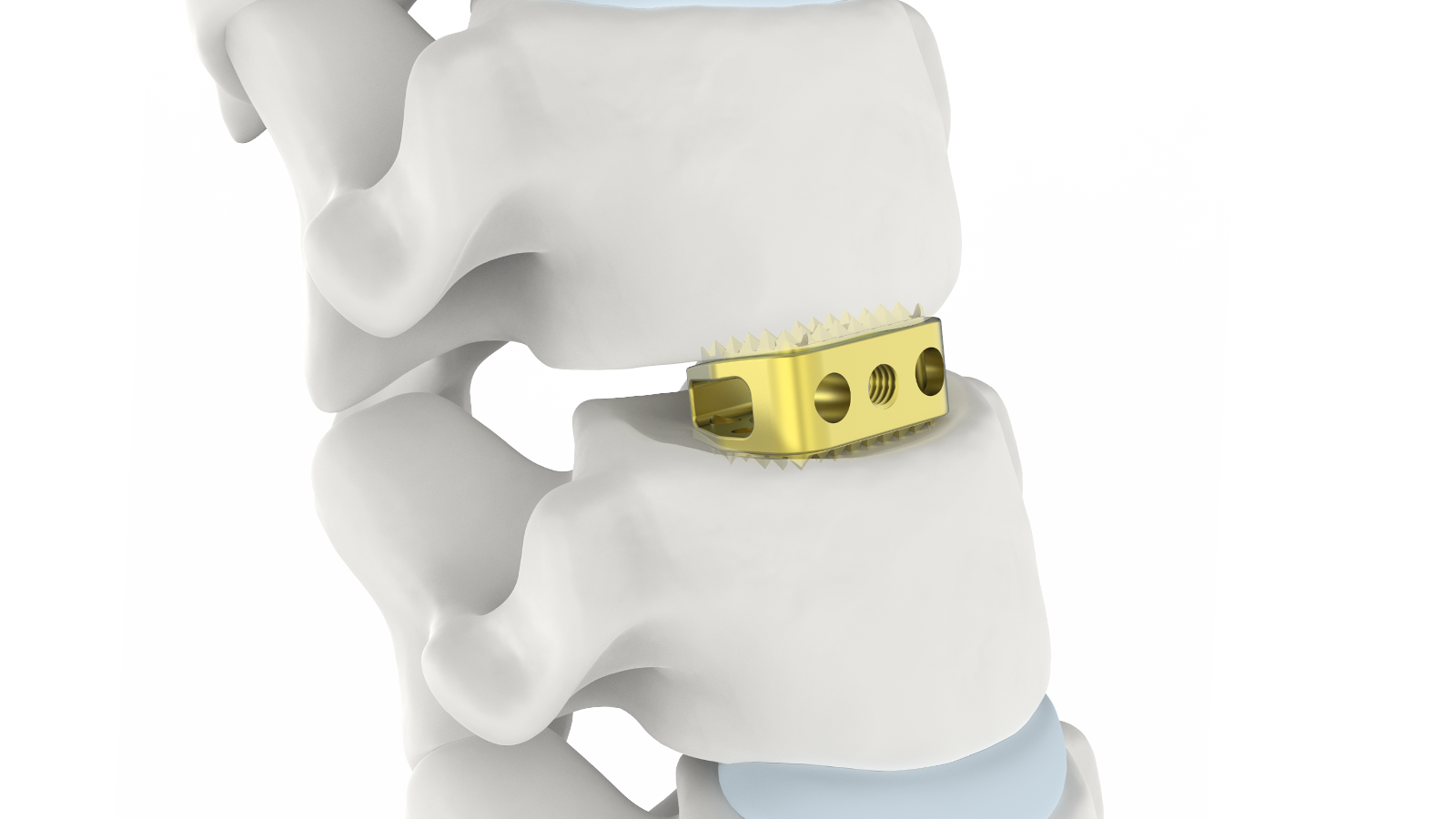 FUSA-CA™ Titanium Cervical Interbody System