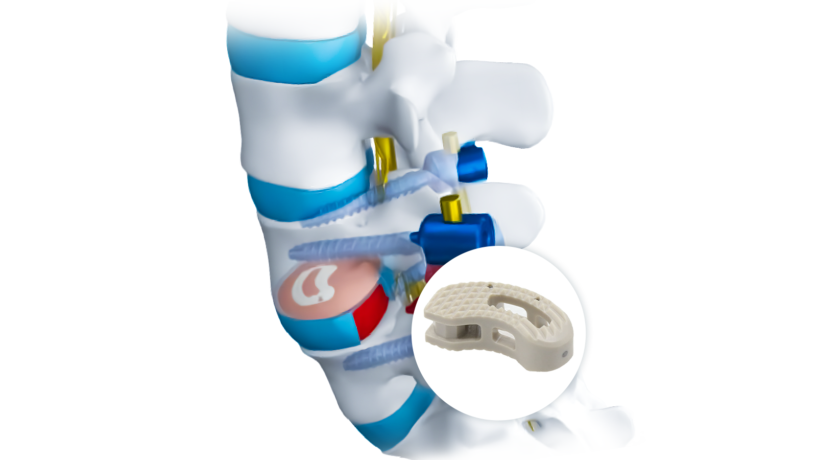 FUSA-TP™ T-PAL PEEK Interbody System