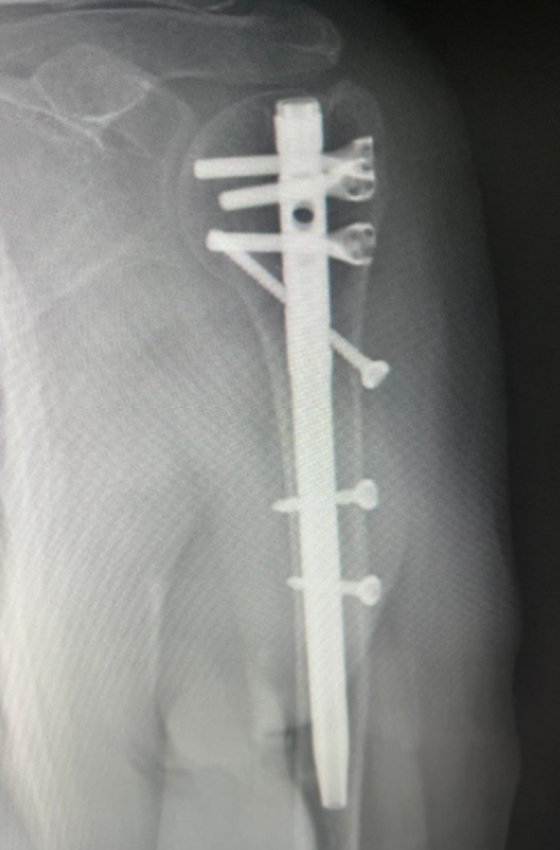 Postoperative X-ray after multi-lock humeral nail fixation