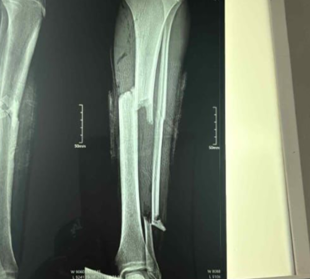 Paired preoperative X-rays showing a partial tibial fracture
