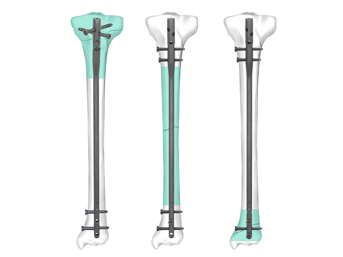 TIVO™ Expert Tibial Nail implant system