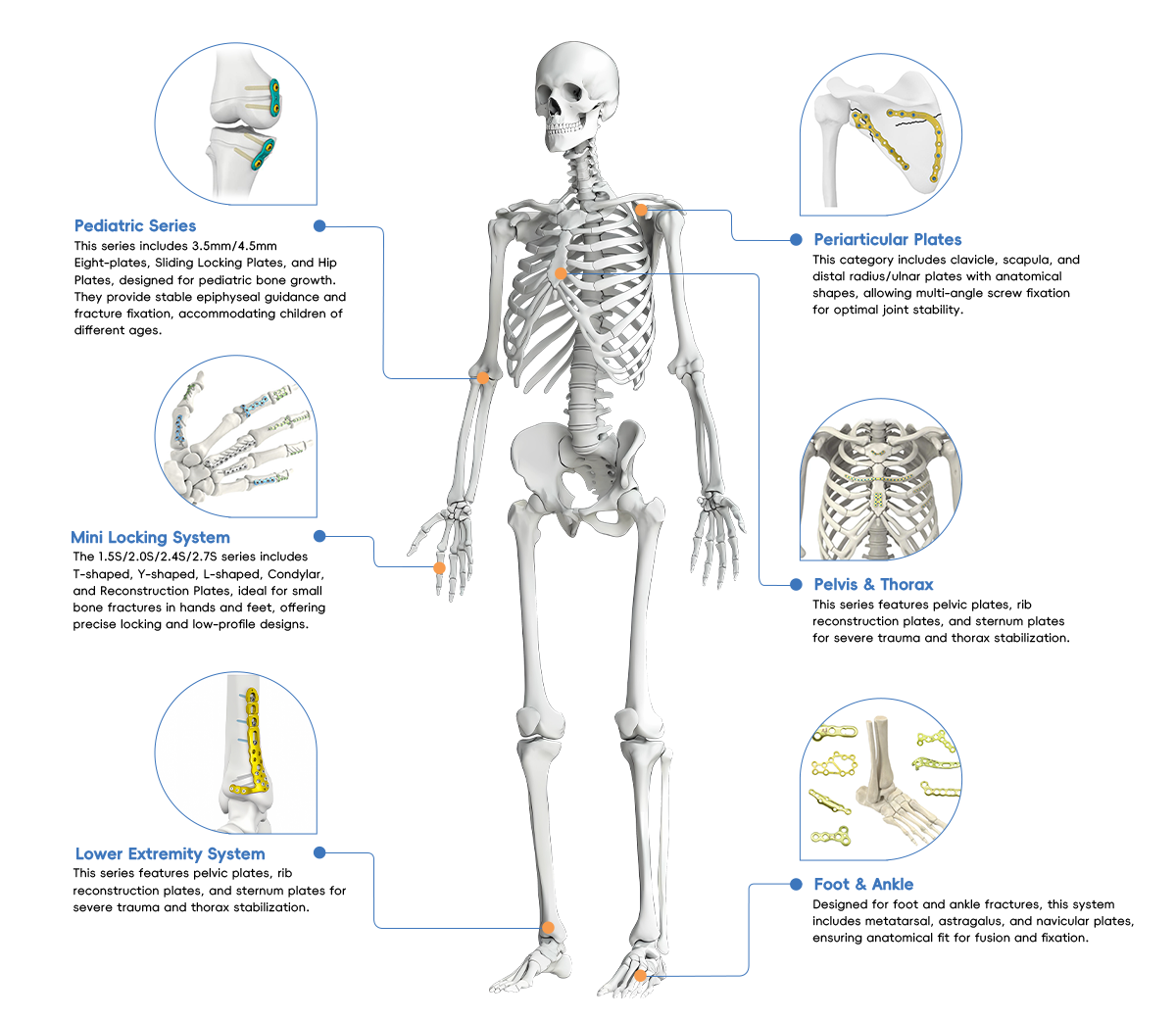locking plate implants.png
