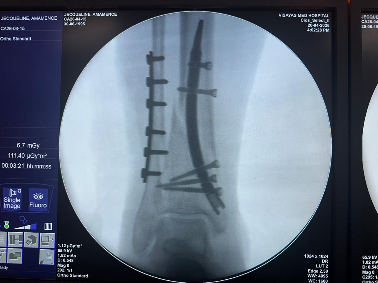 chiodo-tibia-distale-fluoroscopia-intraoperatoria-czmeditech (2)