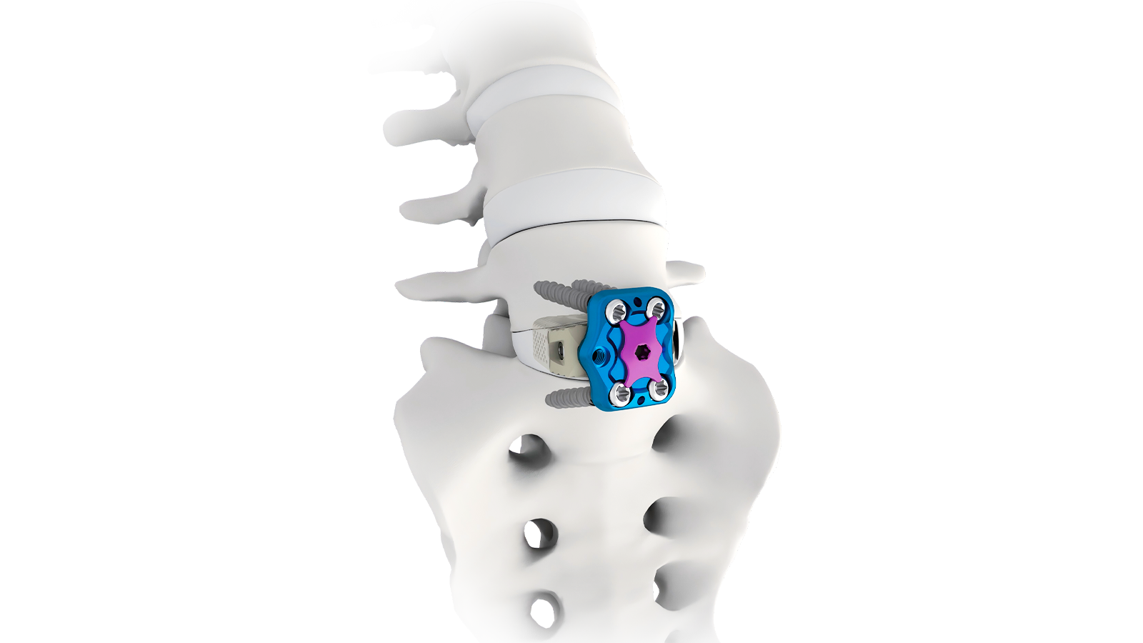 FUSA-A™ ALIF PEEK Interbody System