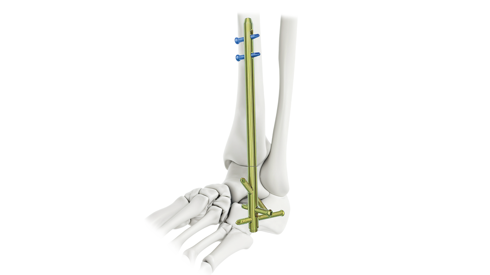 Foot & Ankle intramedullary nail system