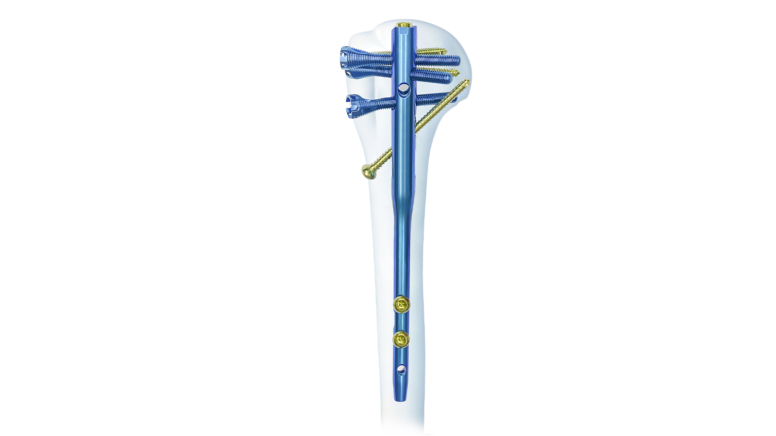 MIVO™ Multi-Lock Humeral Intramedullary Nail