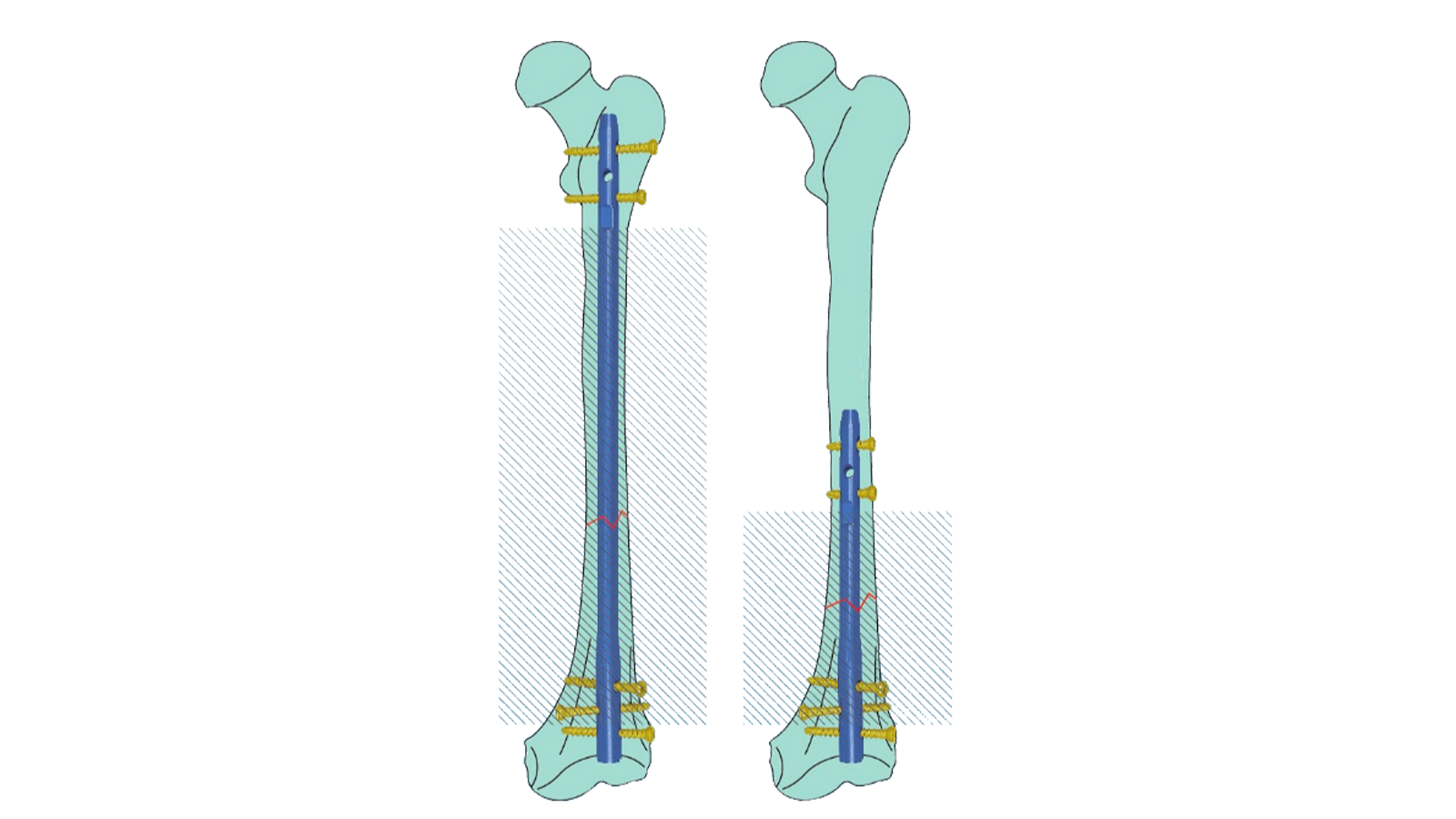 REXO™ Expert Reversed Femoral Intramedullary Nail