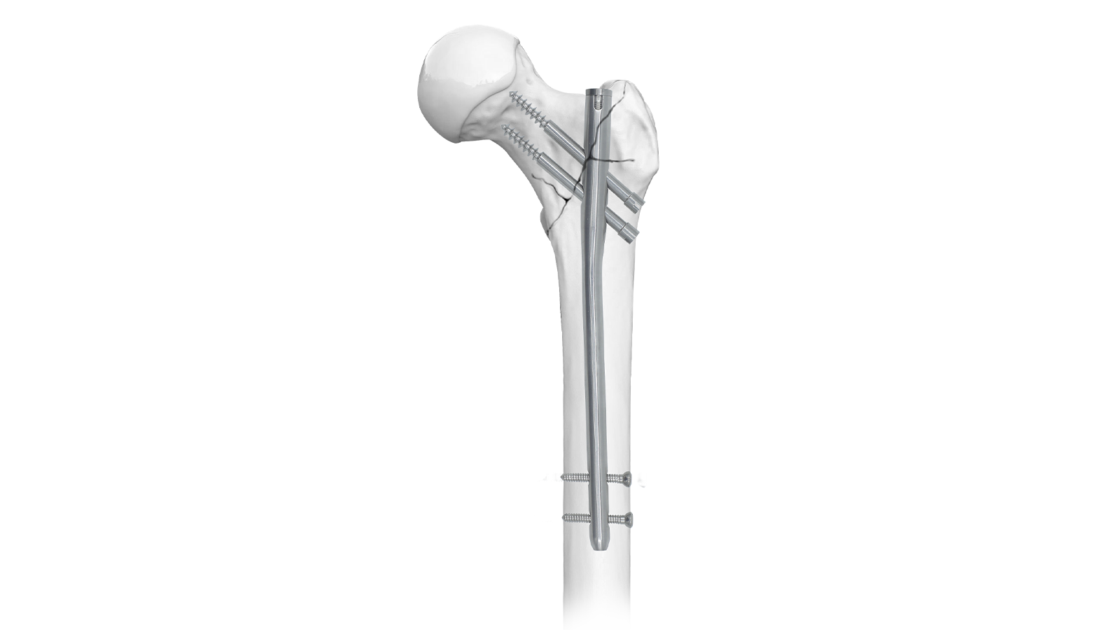 ARVO™ Gamma Intramedullary Nail