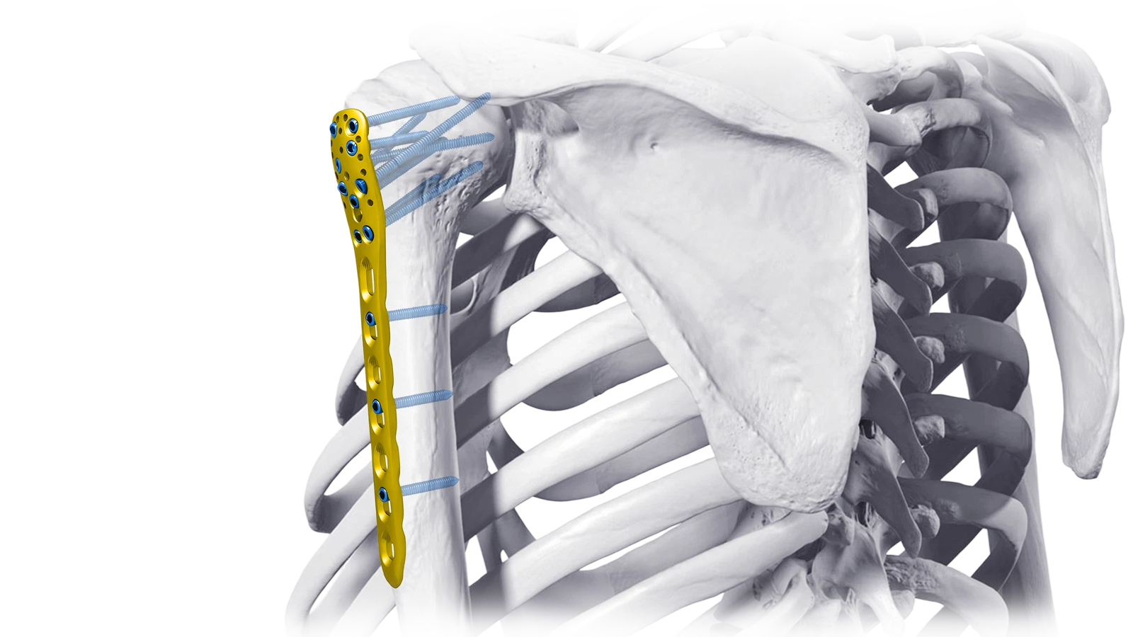 Upper Extremity locking plate system