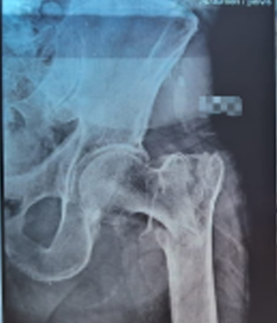 Preoperative AP X-ray showing left intertrochanteric fracture