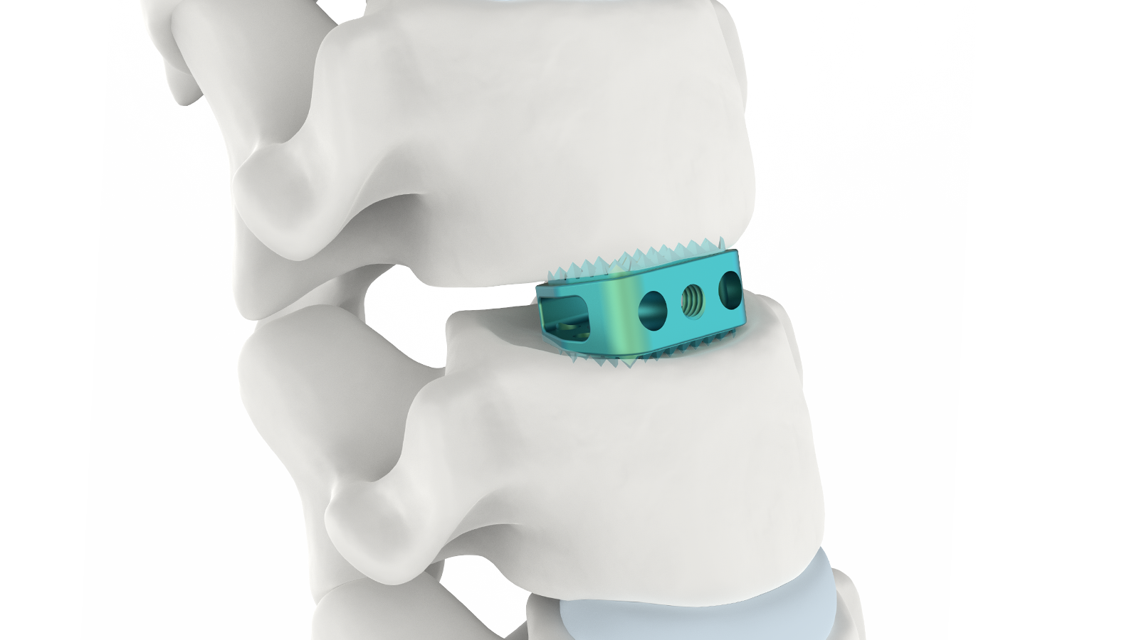 FUSA-CW™ Titanium Cervical Interbody System