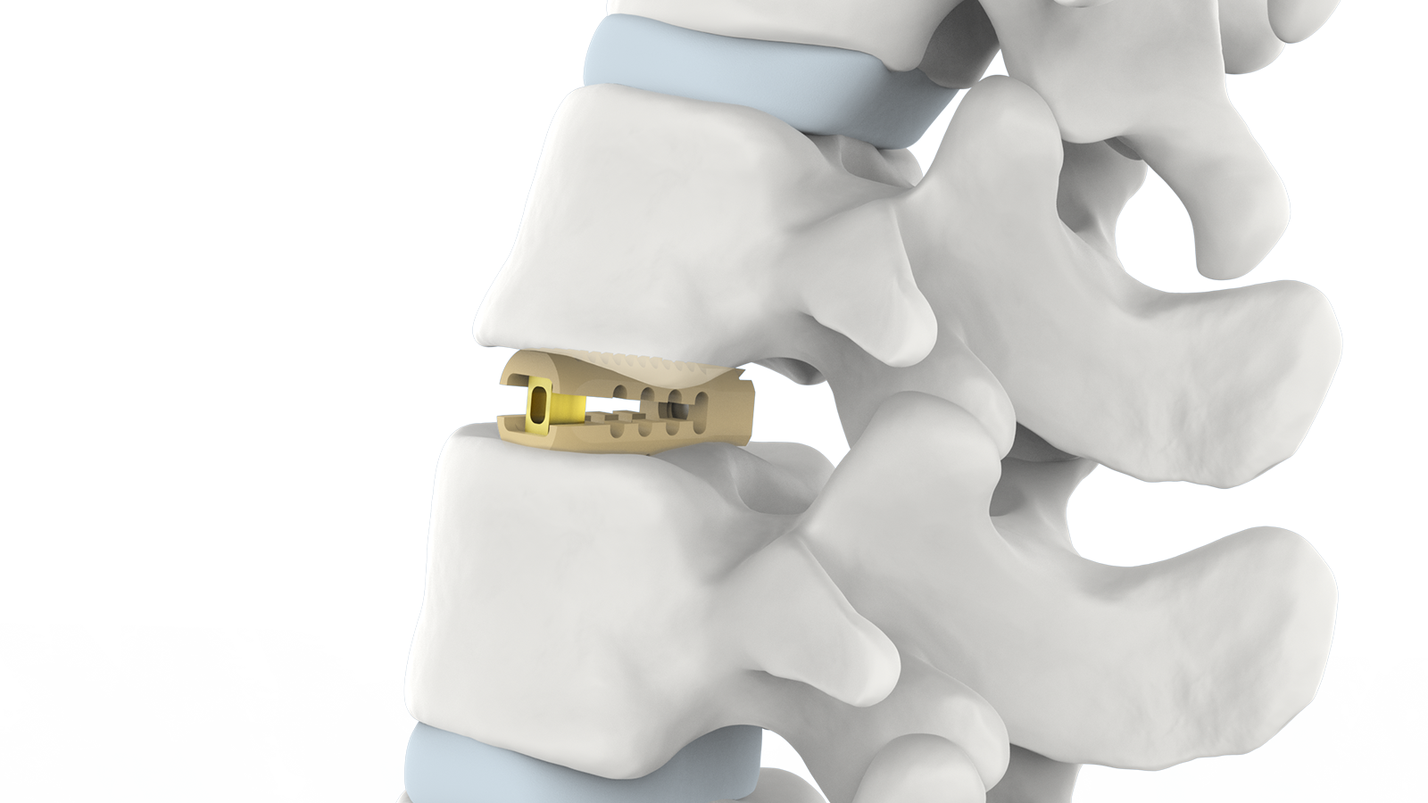 FUSA-RF™ Rafus Lumbale PEEK Interliggaamstelsel