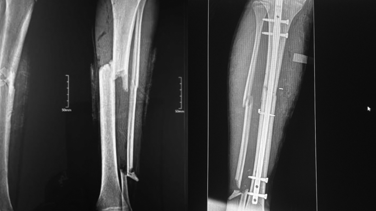 Tibial Fracture Treatment in Mexico—Advanced Internal Fixation with Expert Tibial Nail and Steel Plate — clinical case cover