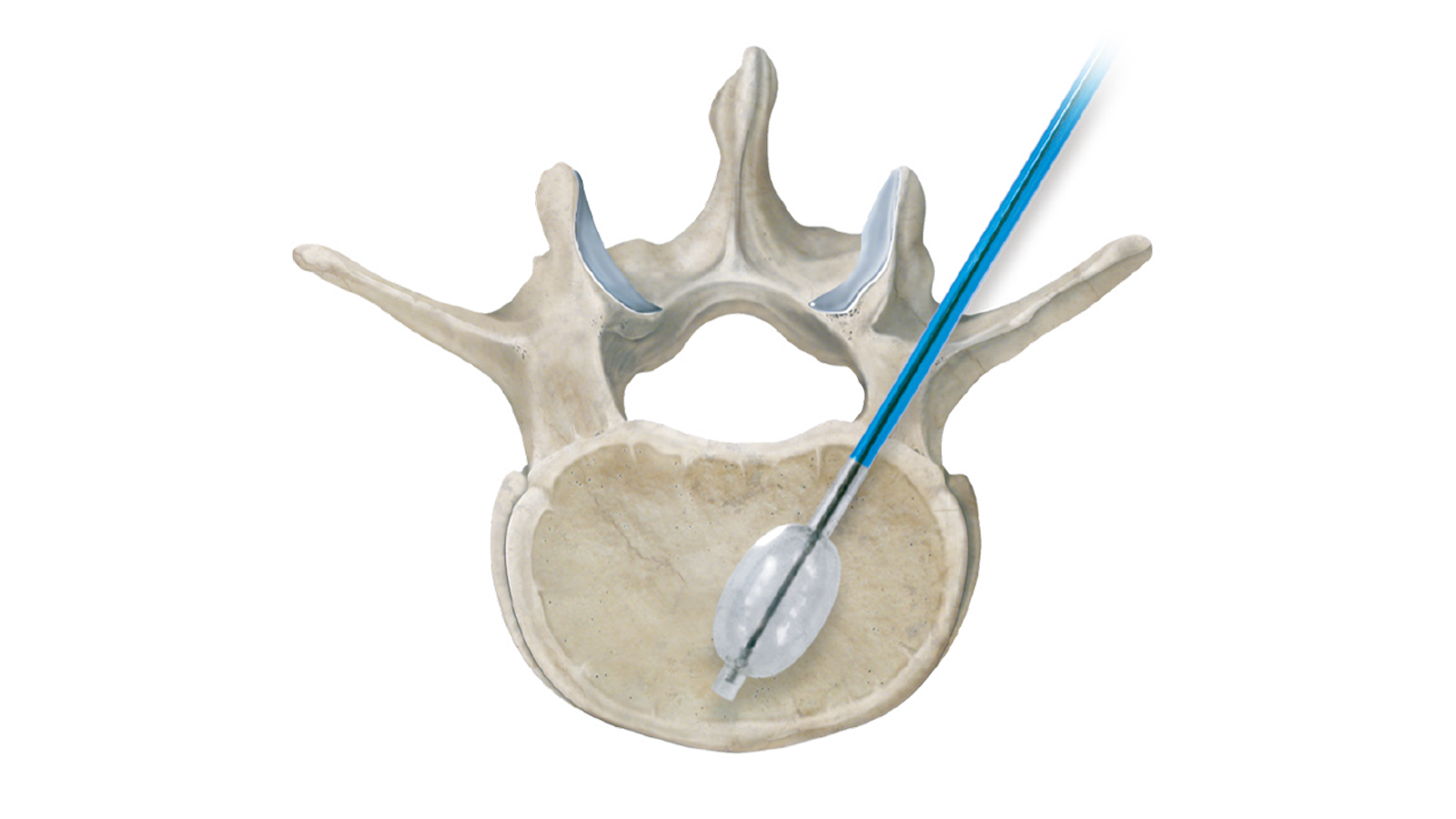 Vertebrale vergrotingstelsel