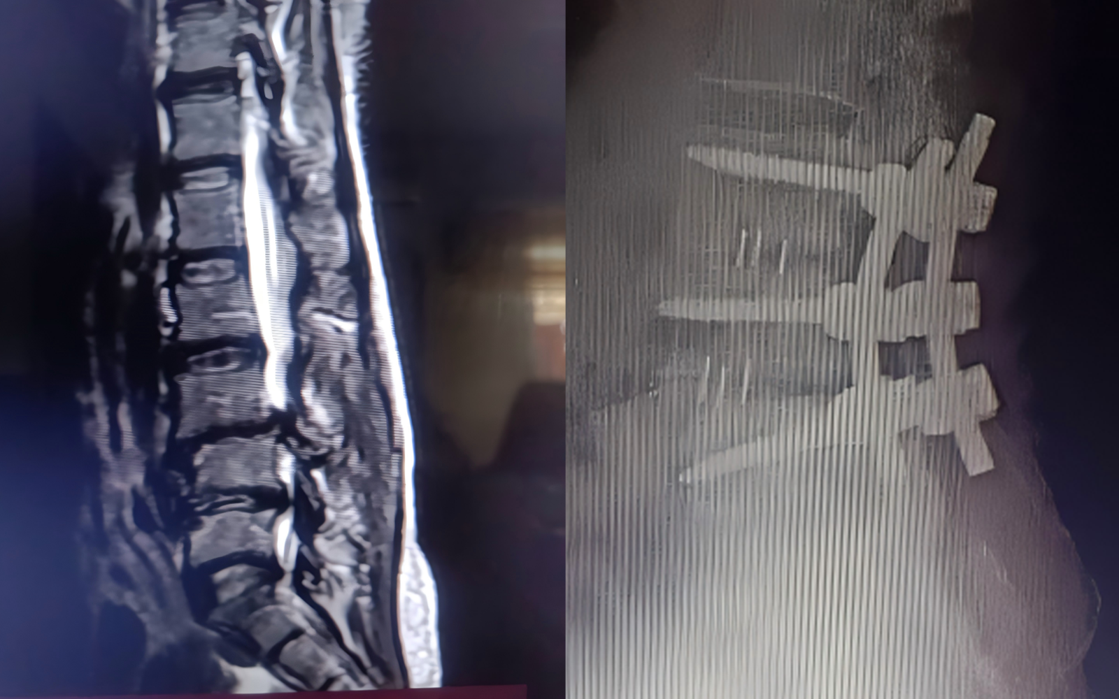 Lumbar spine TLIF surgery case in Nigeria using PEEK cage and pedicle screw system