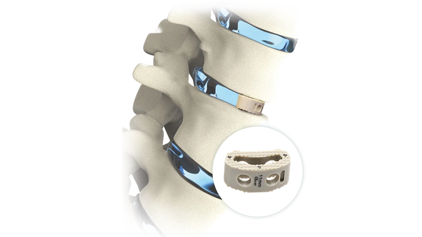 FUSA-TL™ TLIF PEEK Interbody System