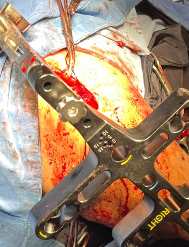 Intraoperative implant insertion and fixation