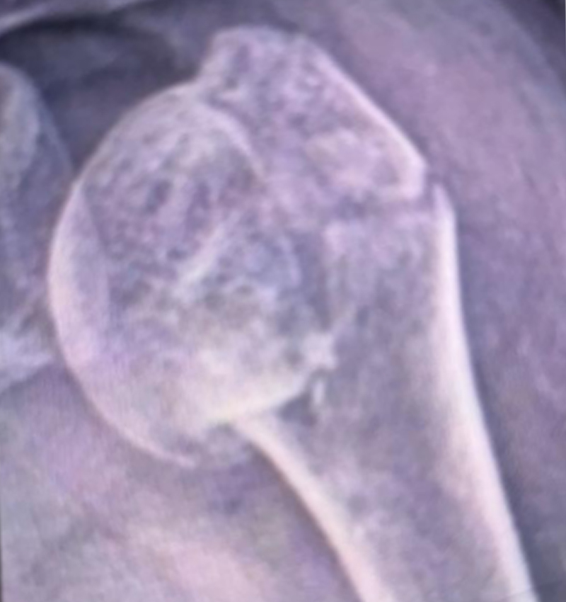 Preoperative X-ray showing humeral head fracture
