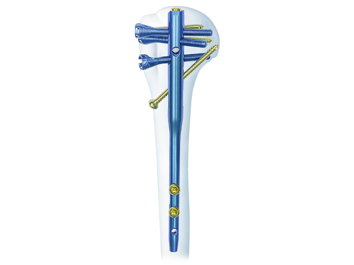 MIVO™ Multi-Lock Humeral Nail implant system