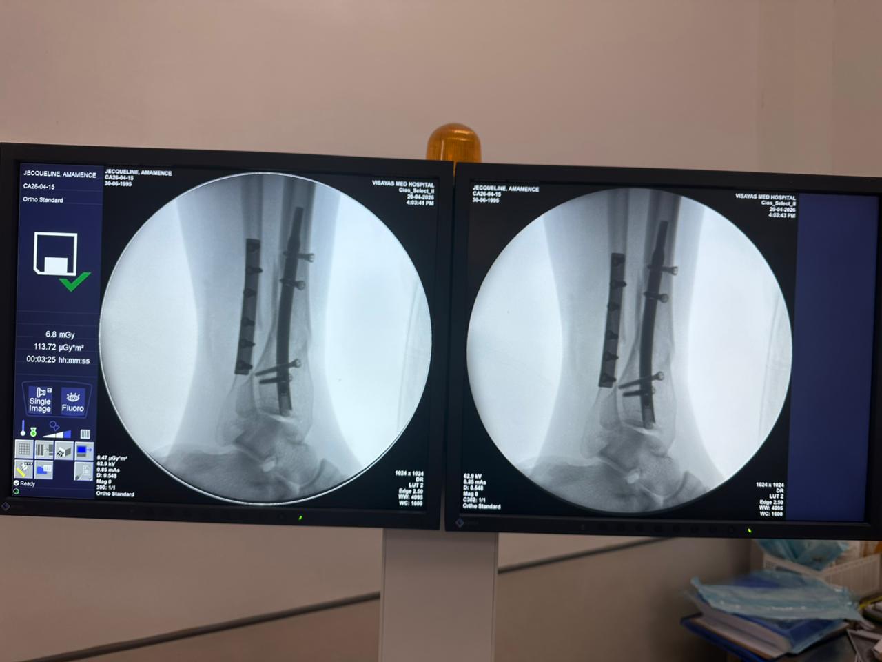 distal-tibial-nail-case-31-year-old-patient-ap-view-czmeditech