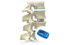 Titanium PLIF lumbalni kavez