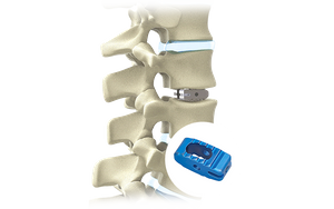 Titanio PLIF Jaula Lumbar rehegua