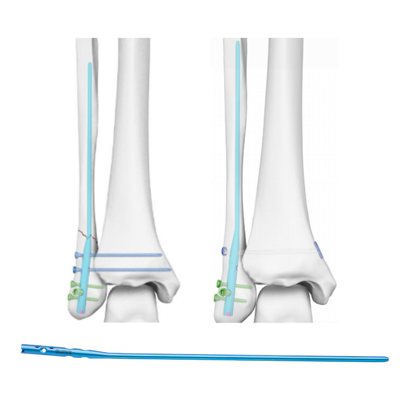 Expert-Fibular-Intramedullary-Nail