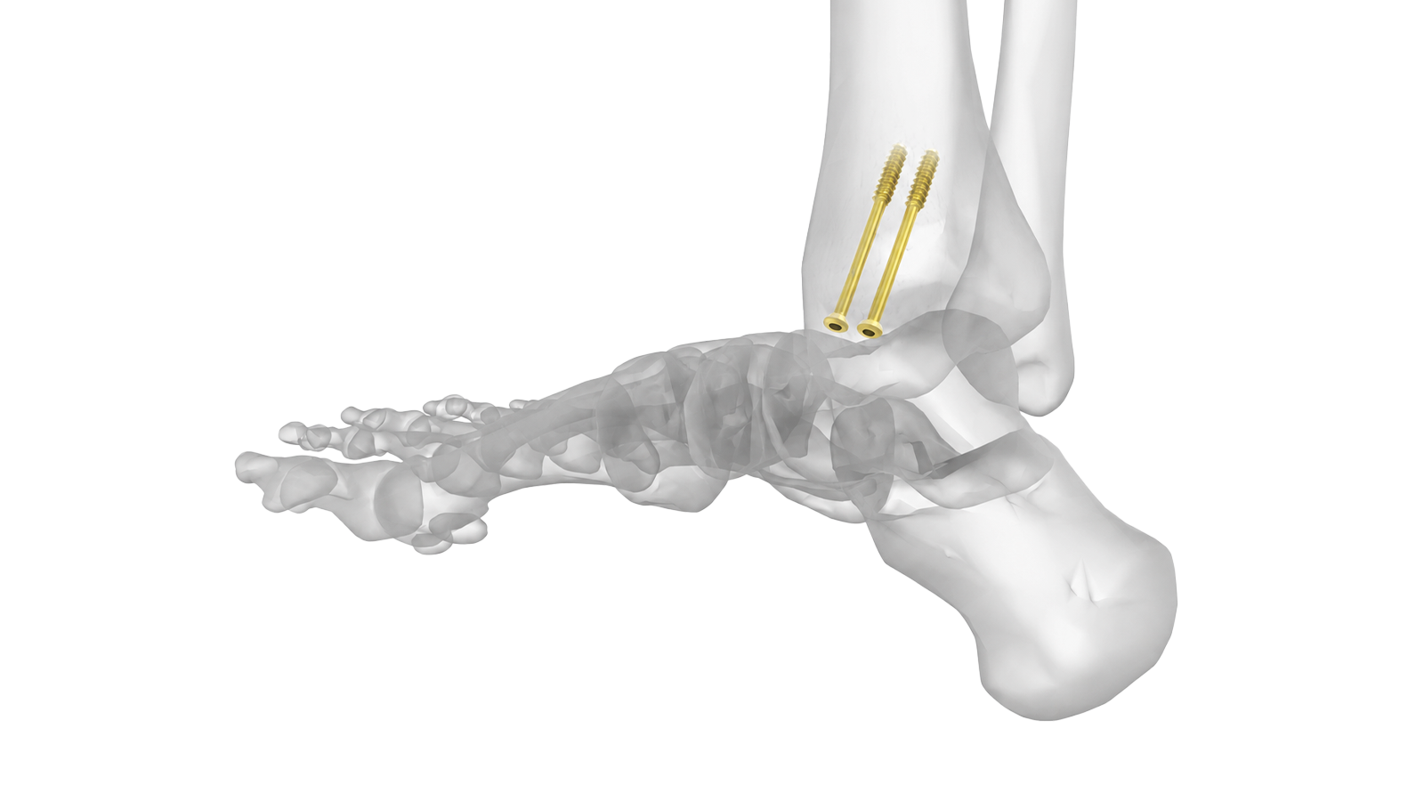 Cannulated screw fixation portfolio
