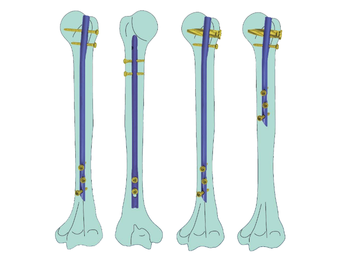 Humerus intramedullary nail system