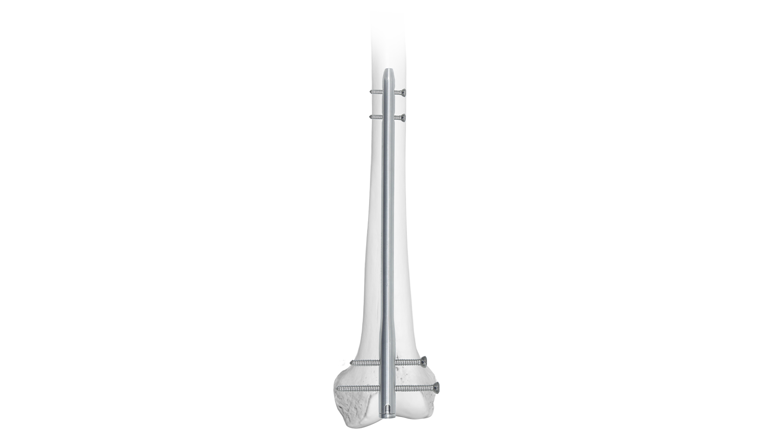 ARVO™ Reversed Femoral Intramedullary Nail