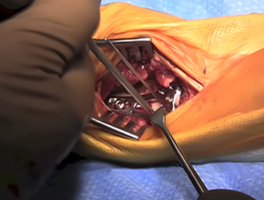 Intraoperative plate and screw positioning