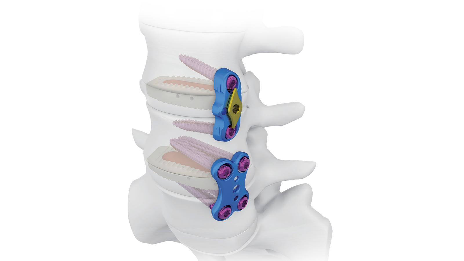 FUSA-O™ OLIF PEEK Interbody System