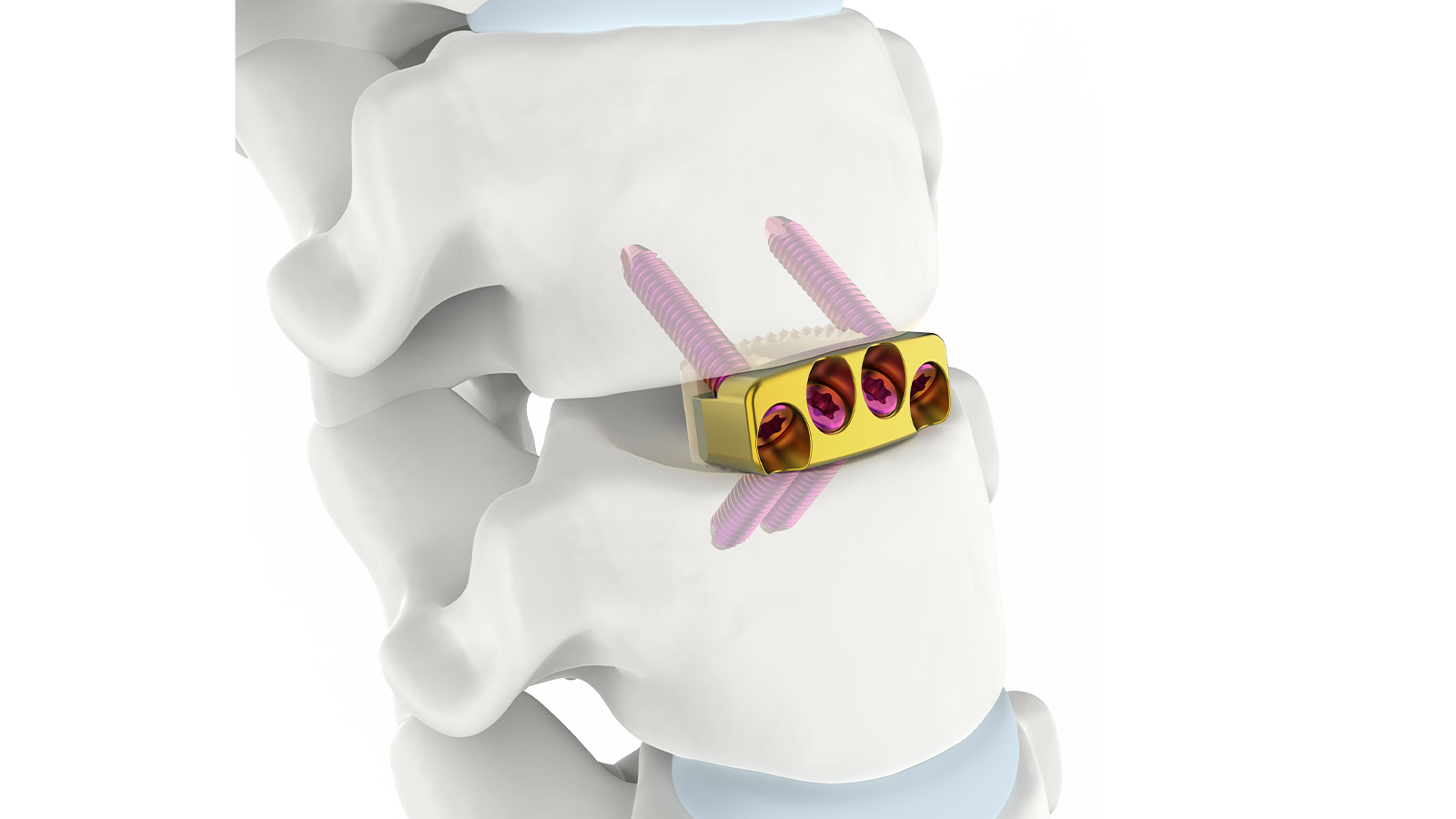 FUSA-C4™ Stand-Alone Cervical PEEK Interbody System