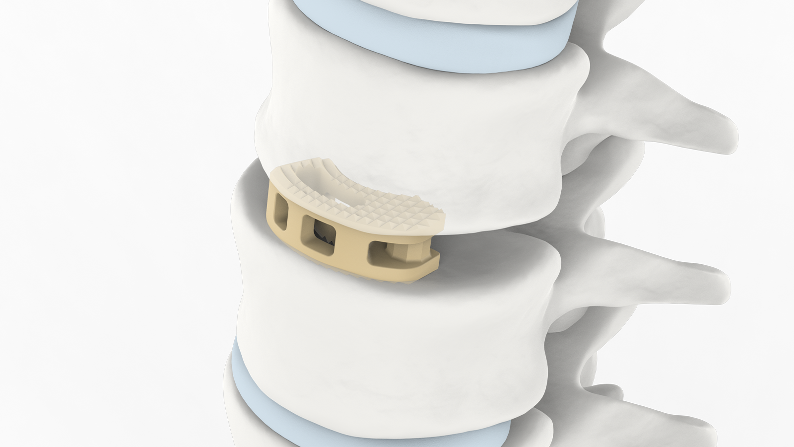 Lumbale tussenliggaamstelsel