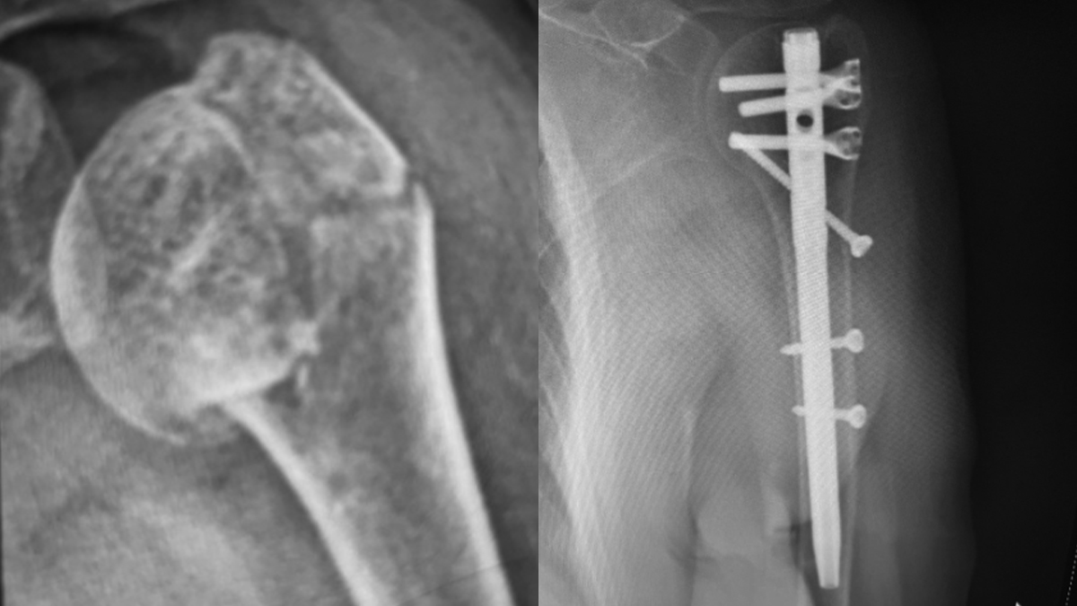 Successful Treatment of A Humeral Head Fracture in Mexico — clinical case cover