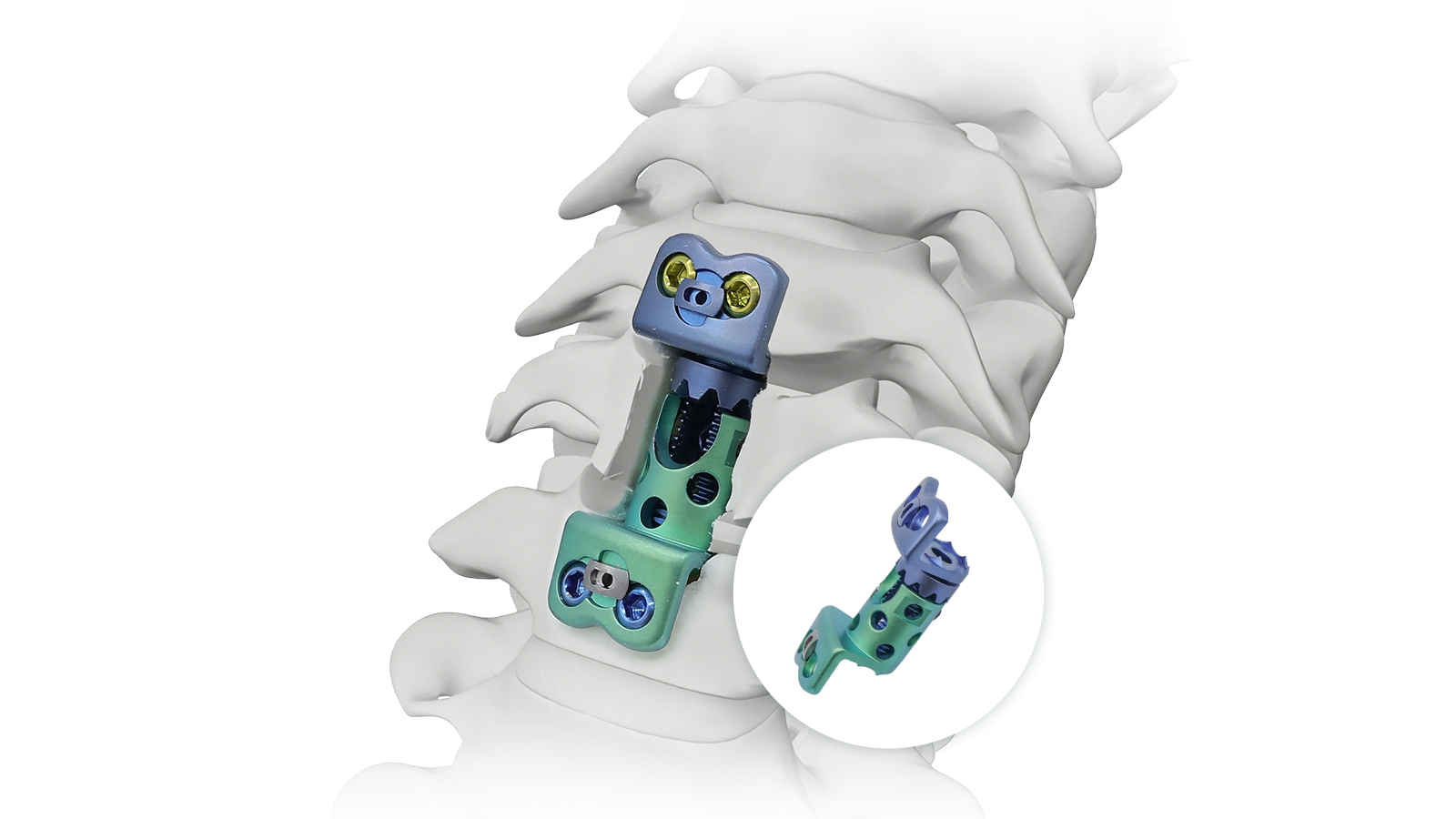 Vertebral Body Replacement nhyehyɛe