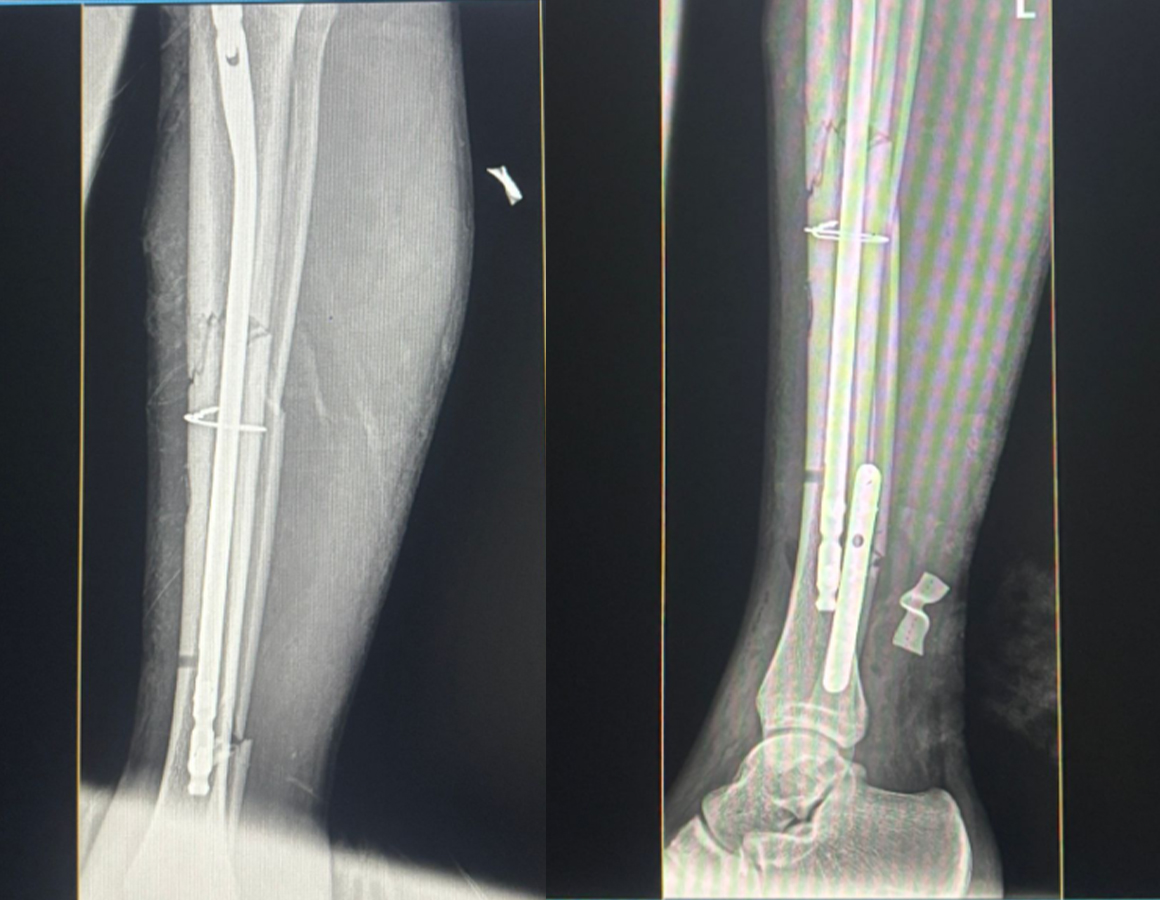 Paired postoperative X-rays showing tibial nail and circular plate fixation