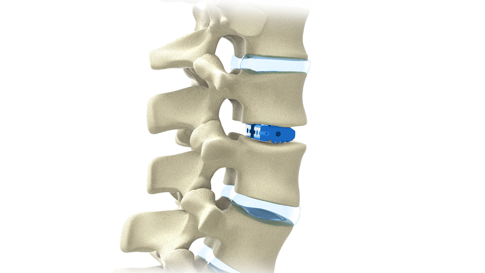 FUSA-PL Ti™ Titanium PLIF Interbody System