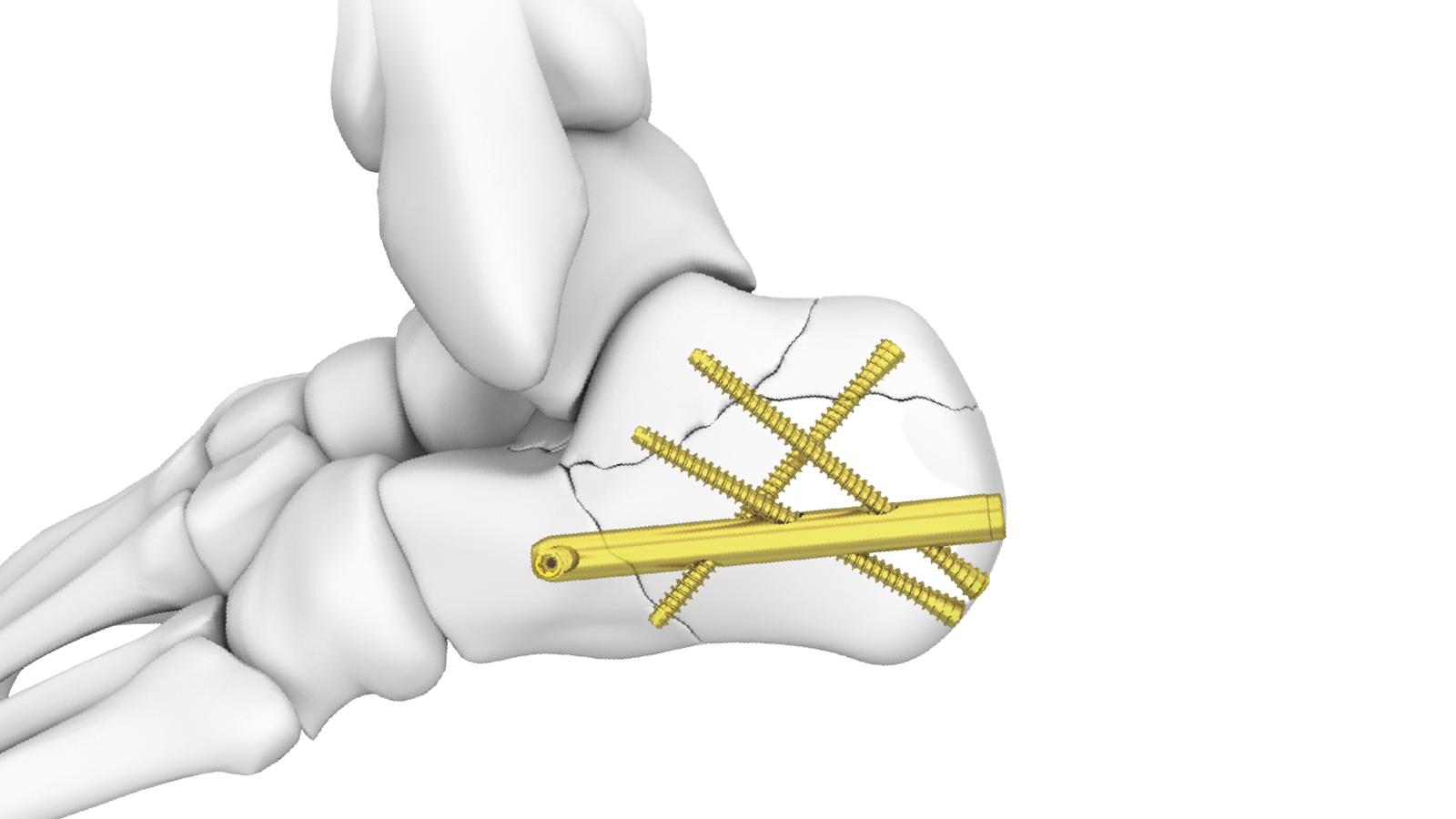 CALX™ Calcaneal Intramedullary Nail