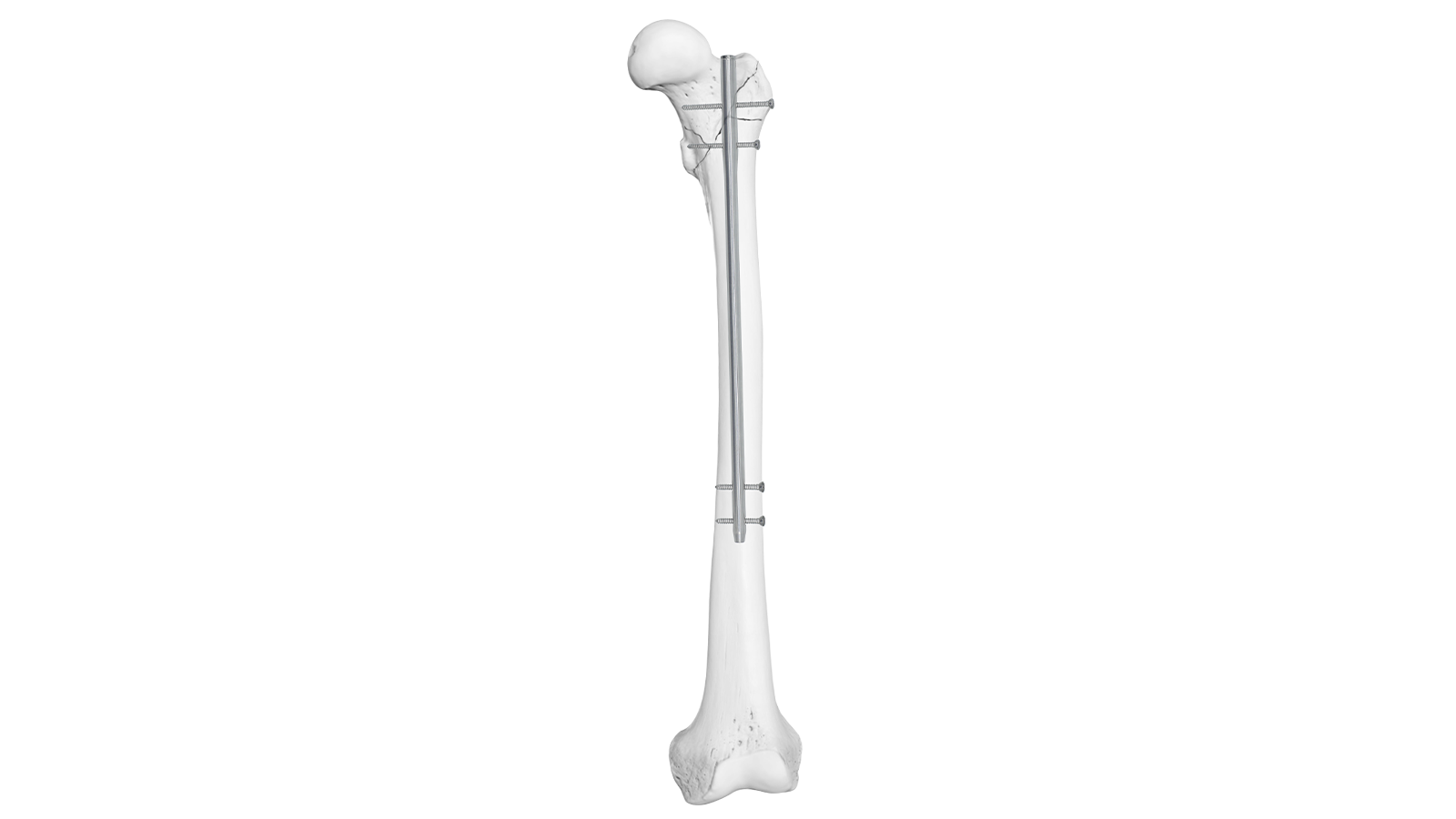 ARVO™ Femoral Intramedullary Nail